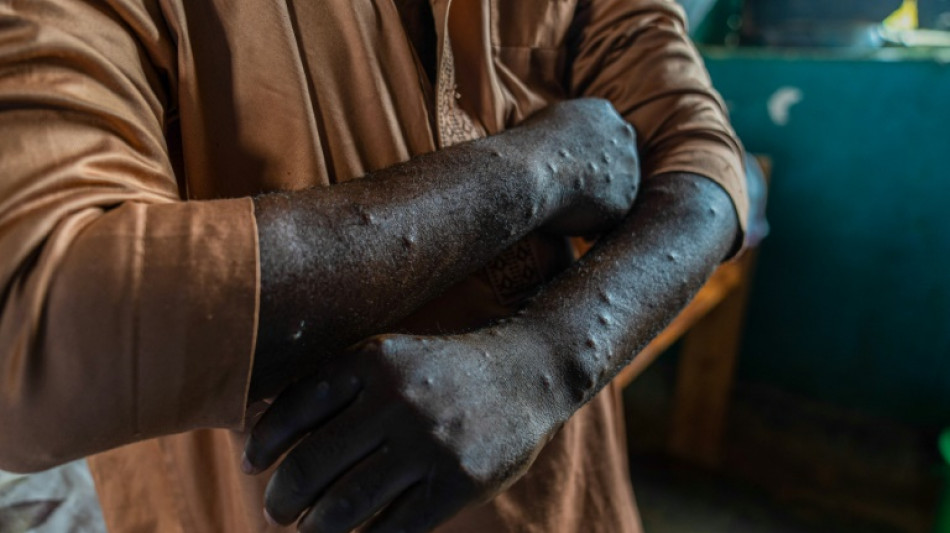 Epidémie de mpox: l'OMS maintient son plus haut niveau d'alerte 