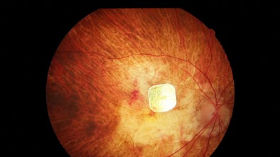 Retina artificiale migliora vista di pazienti con grave malattia